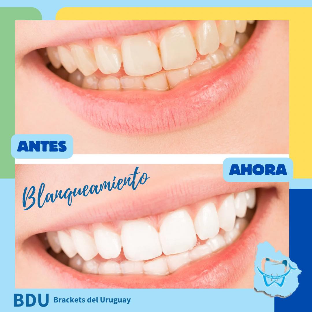 Blanqueamiento dental antes y después