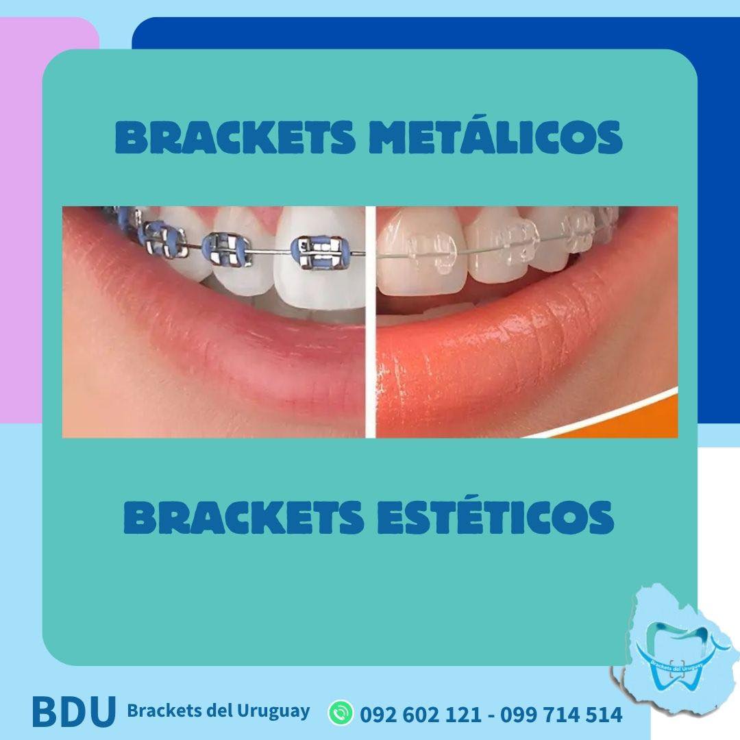 Brackets metálicos y estéticos