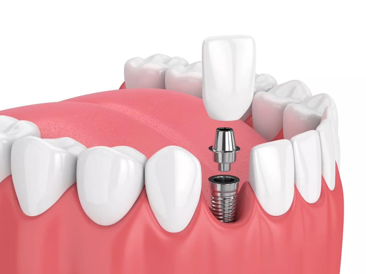 Implantes dentales